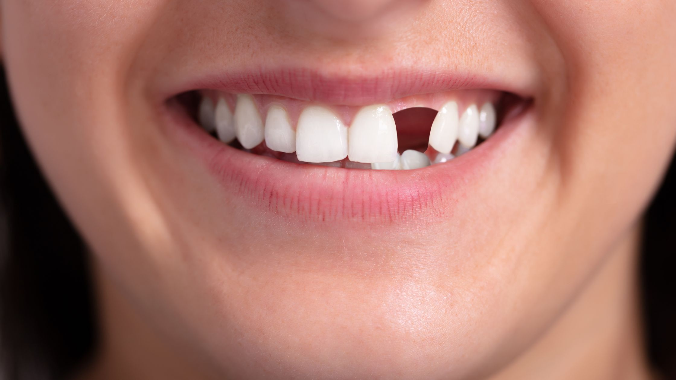 Types of Tooth Replacements and Which One is Right for You